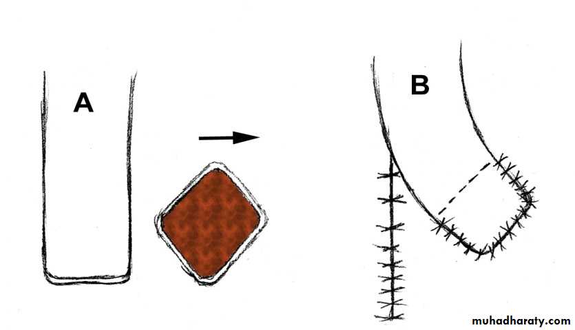 Basic principles in plastic surgery