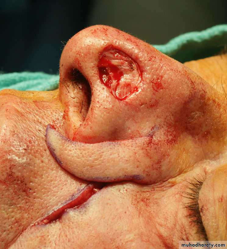 Basic principles in plastic surgery