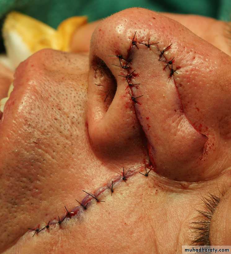 Basic principles in plastic surgery