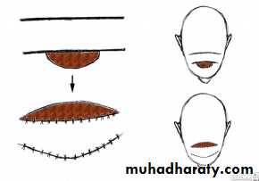 Basic principles in plastic surgery