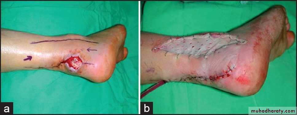 Basic principles in plastic surgery
