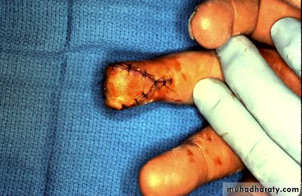 Basic principles in plastic surgery