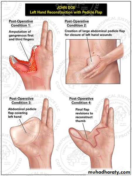 Basic principles in plastic surgery