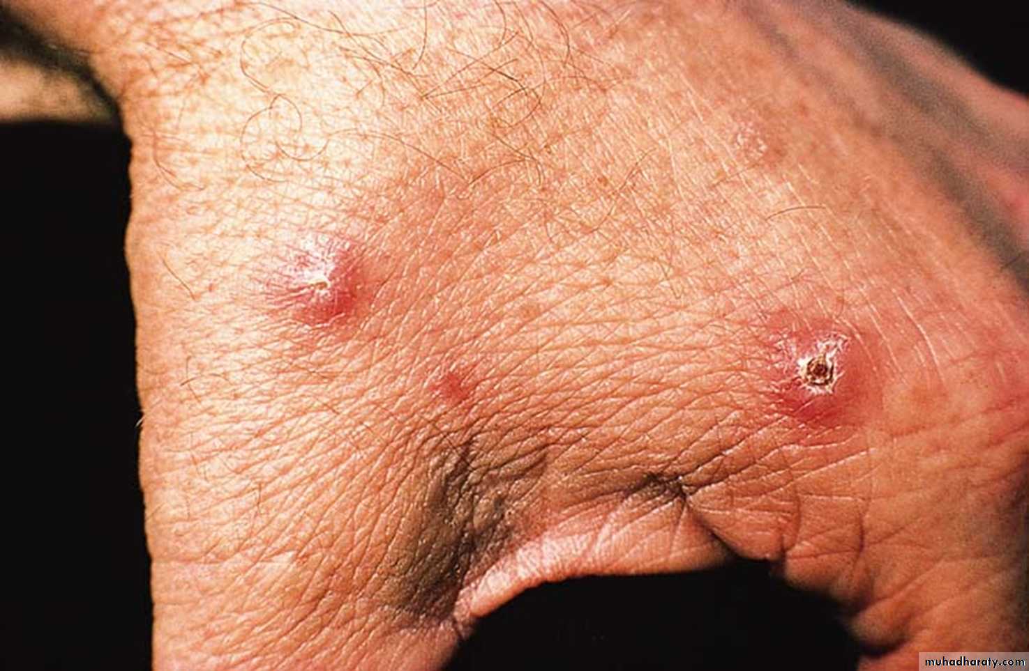 parasitic skin diseases