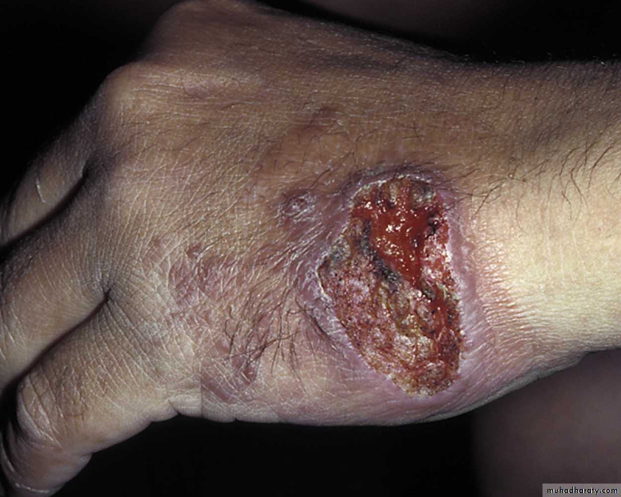 parasitic skin diseases