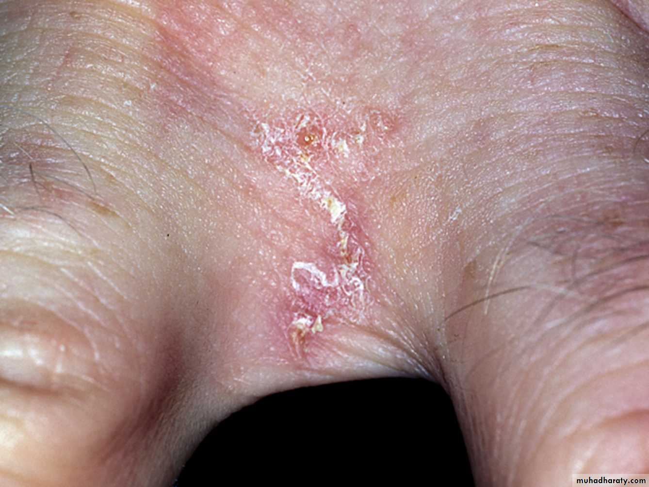 parasitic skin diseases