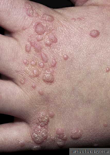 Viral skin diseases