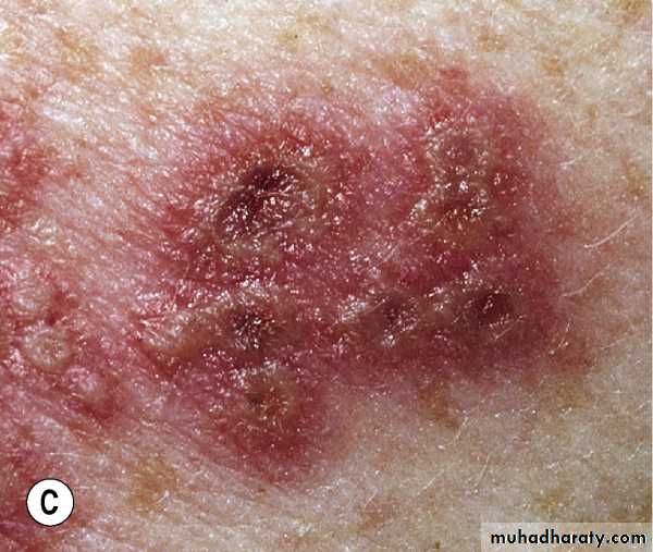 Viral skin diseases