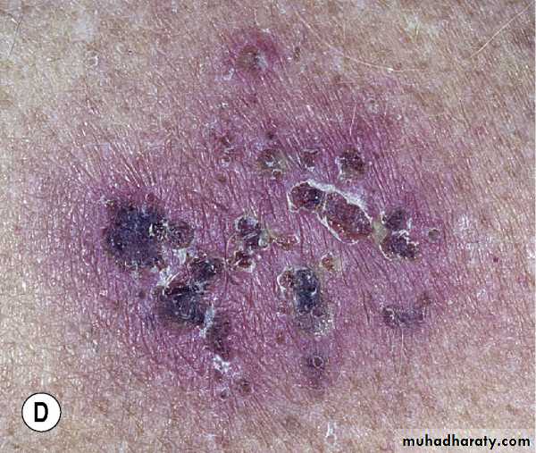 Viral skin diseases