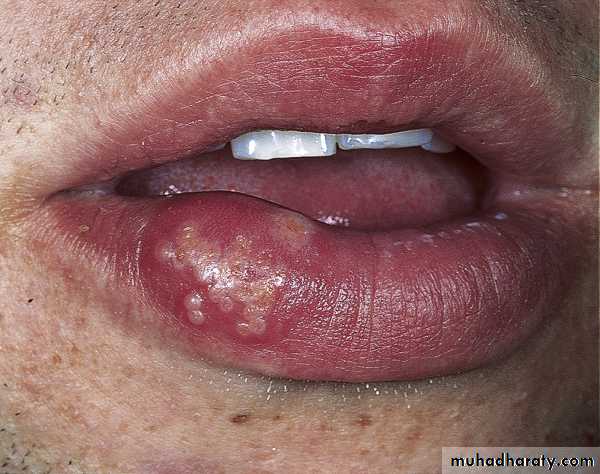 Viral skin diseases