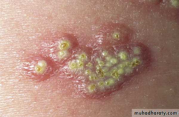 Viral skin diseases