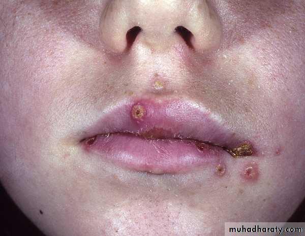 Viral skin diseases