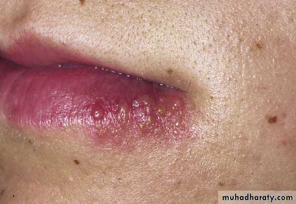 Viral skin diseases
