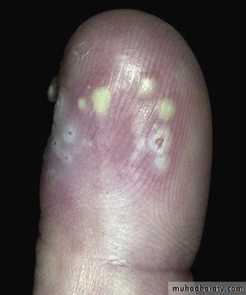 Viral skin diseases