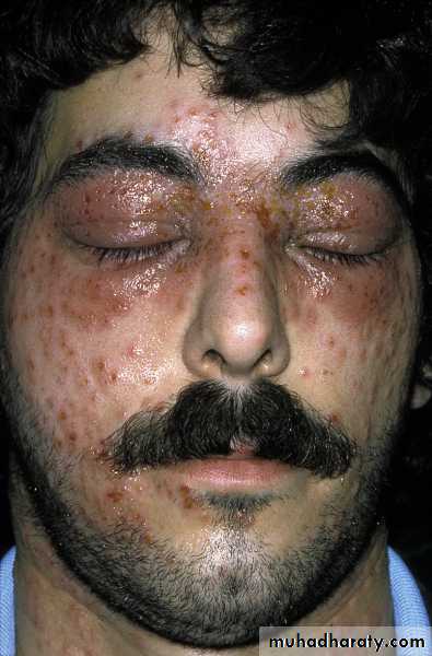 Viral skin diseases