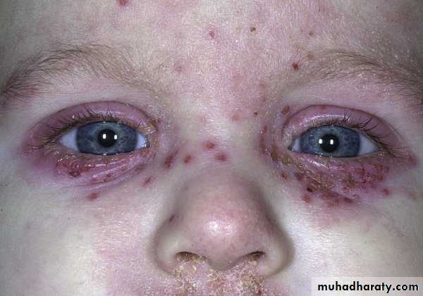 Viral skin diseases