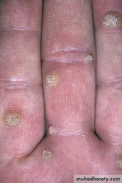 Viral skin diseases