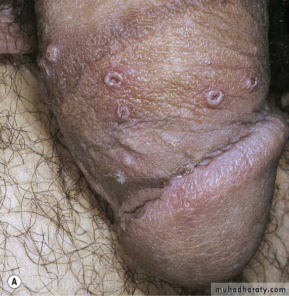 Viral skin diseases
