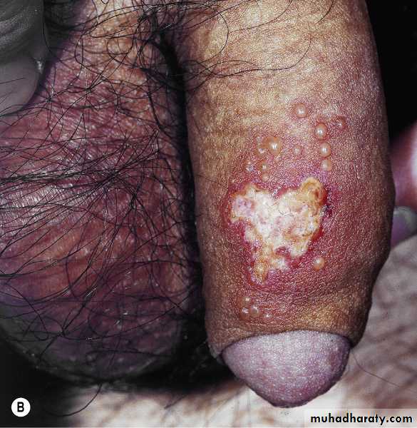 Viral skin diseases