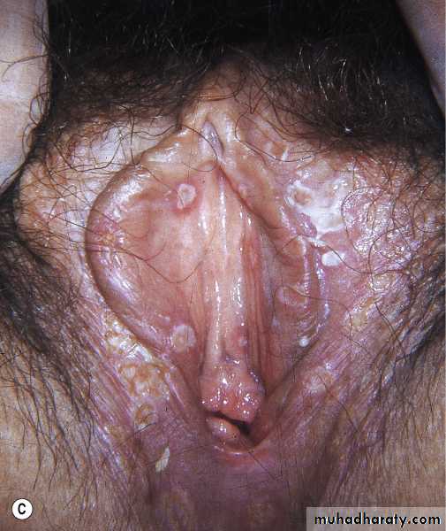 Viral skin diseases