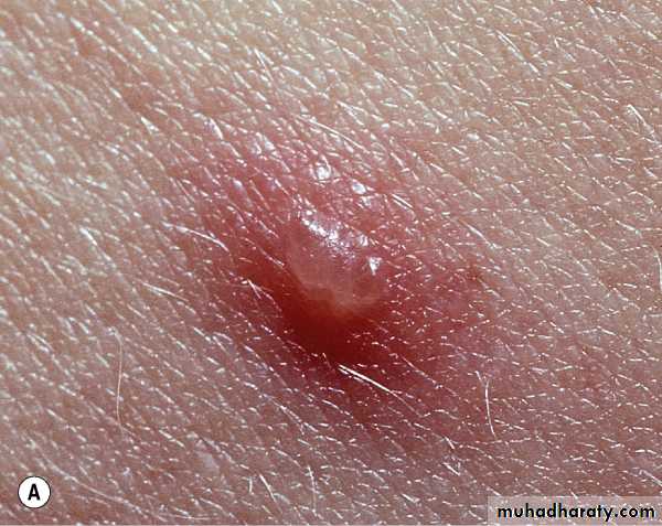 Viral skin diseases