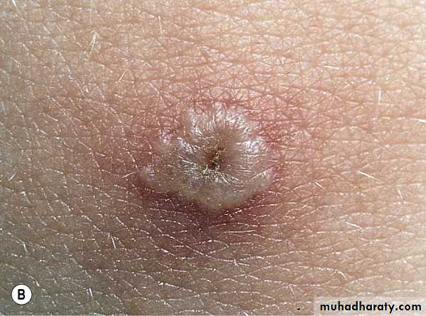 Viral skin diseases