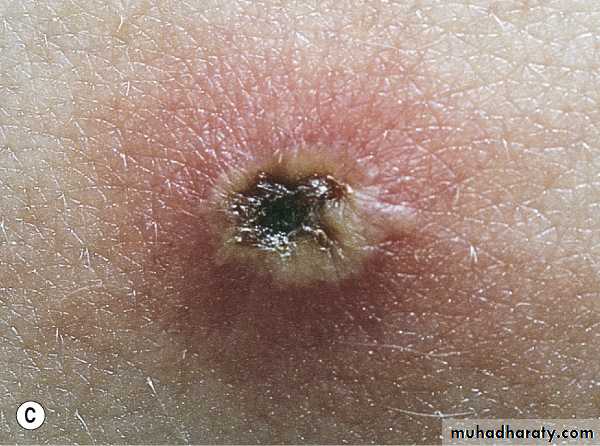Viral skin diseases