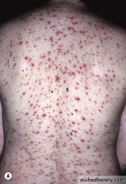 Viral skin diseases