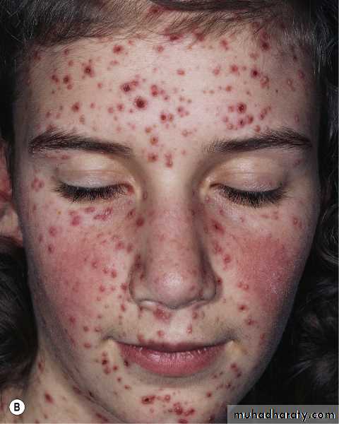 Viral skin diseases