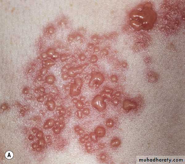 Viral skin diseases