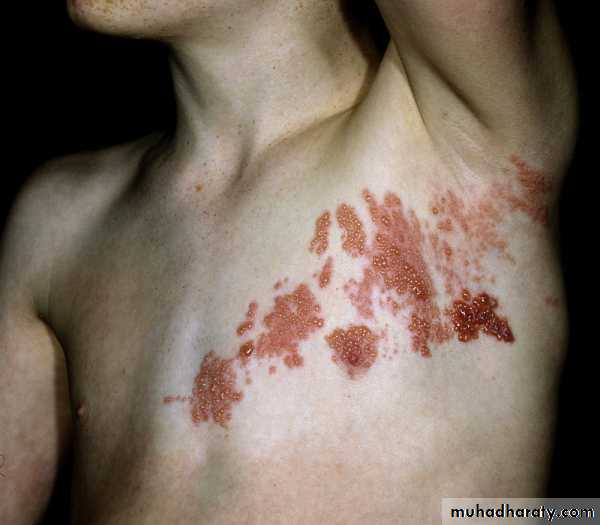 Viral skin diseases