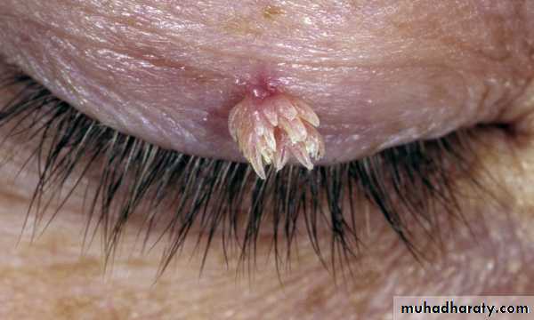 Viral skin diseases