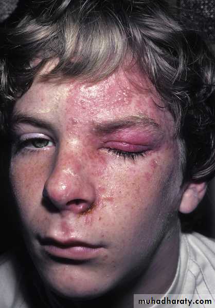 Viral skin diseases