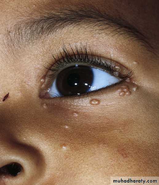 Viral skin diseases