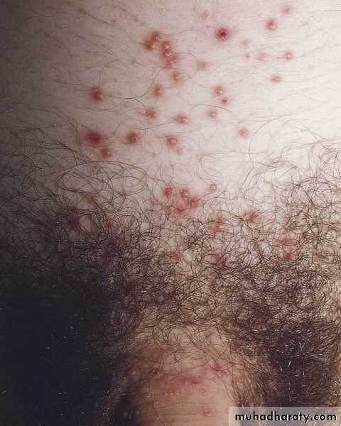 Viral skin diseases