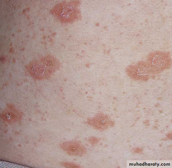 Viral skin diseases