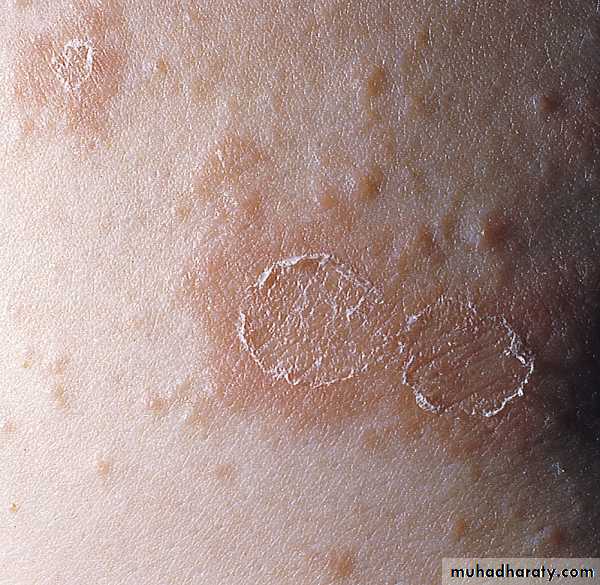Viral skin diseases