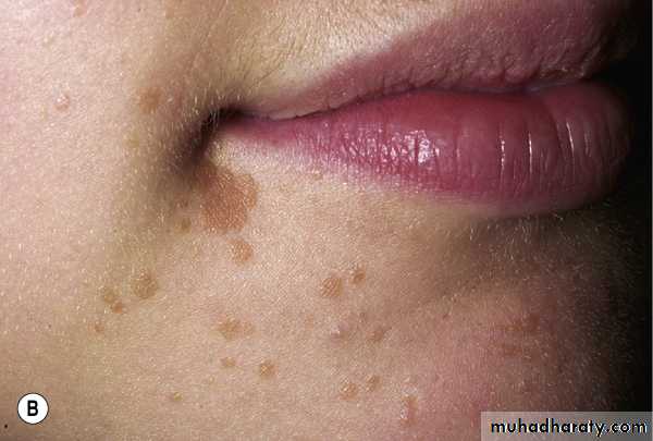 Viral skin diseases