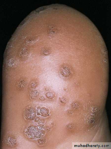 Viral skin diseases