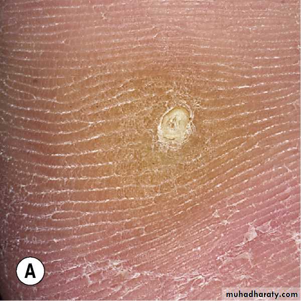 Viral skin diseases