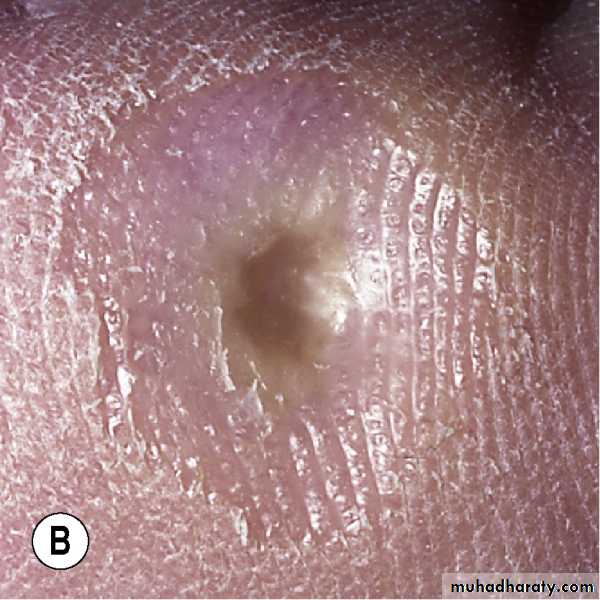 Viral skin diseases