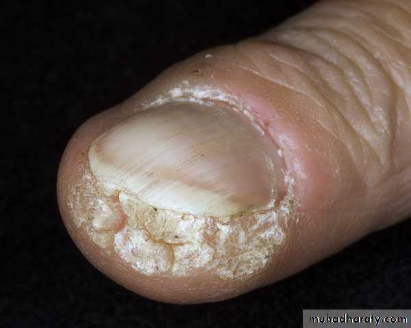 Viral skin diseases