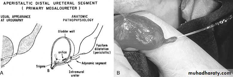 Congenital anomalies of the upper urinary tract