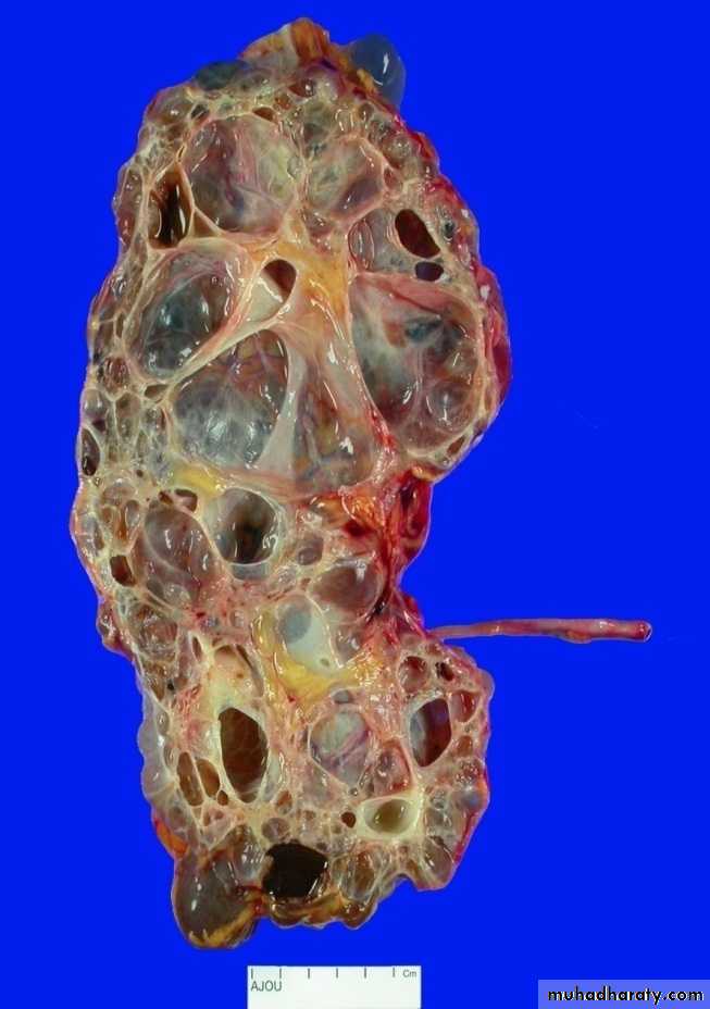 Congenital anomalies of the upper urinary tract