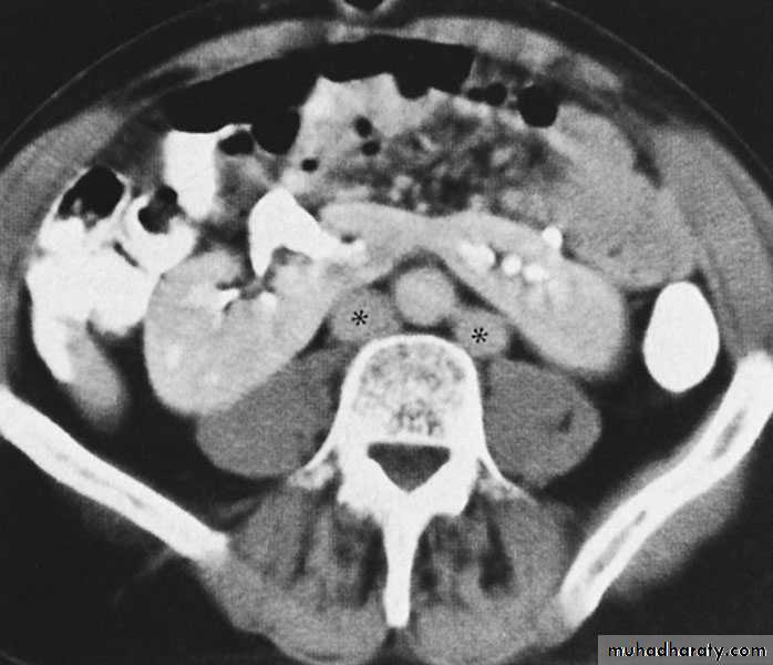 Congenital anomalies of the upper urinary tract