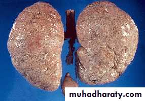 Congenital anomalies of the upper urinary tract