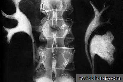 Congenital anomalies of the upper urinary tract