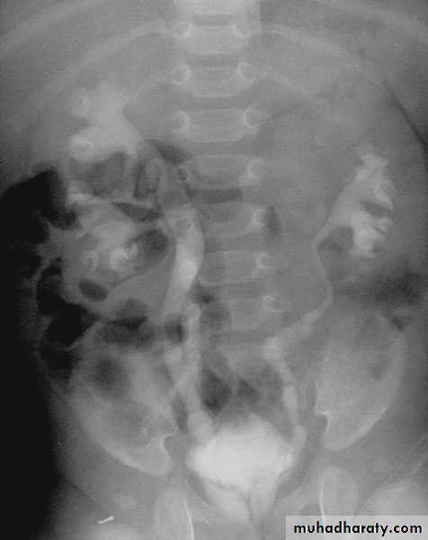 Congenital anomalies of the upper urinary tract