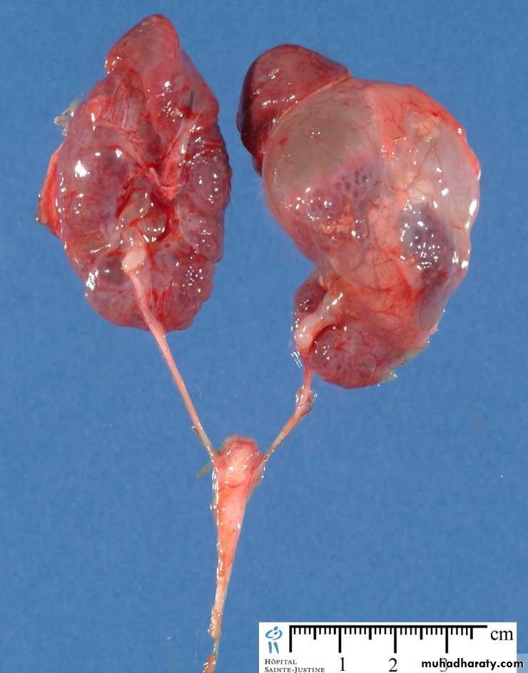 Congenital anomalies of the upper urinary tract