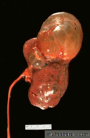Congenital anomalies of the upper urinary tract